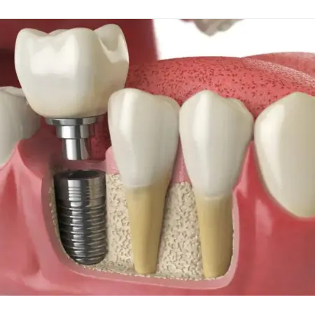proces zarastanja implantata
