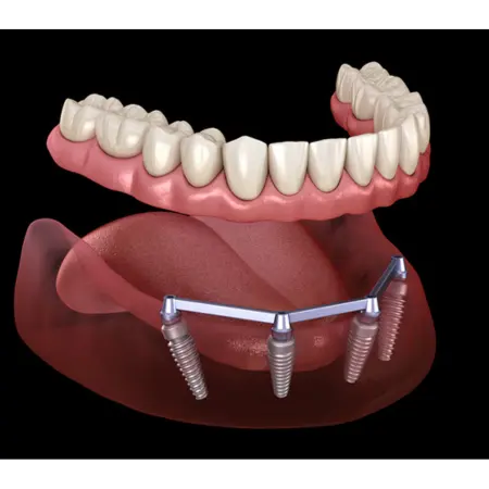 implantati ALL-ON-4