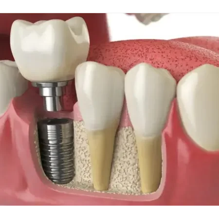 proces zarastanja implantata